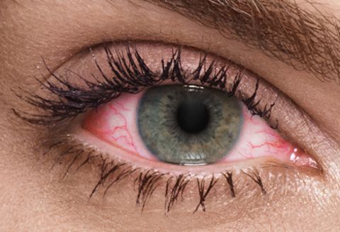 Iperemia congiuntivale